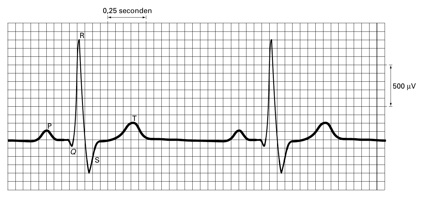 0,25 seconden R 500 µV T P Q S